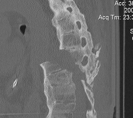 Ankylosing Spondylitis Thoracic Fracture CT